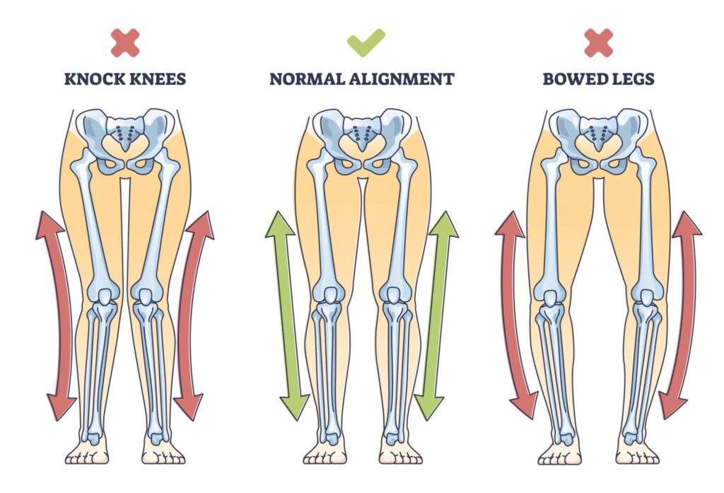 Varus Knee Alignment and Osteoarthritis: How Medical Yoga Therapy Helps
