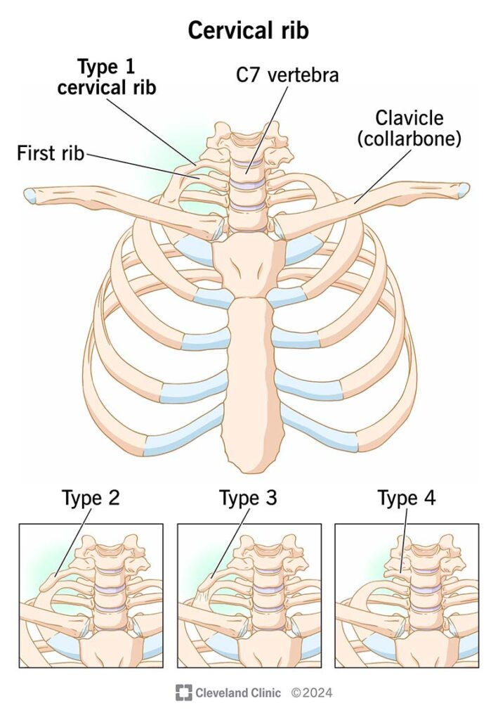 Cervical Rib