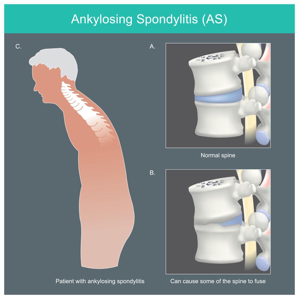 Understanding the ‘Spondy’ Trio: Spondylosis, Spondylitis, and Spondylolysis
