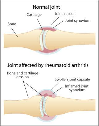 What is Joint Inflammation?