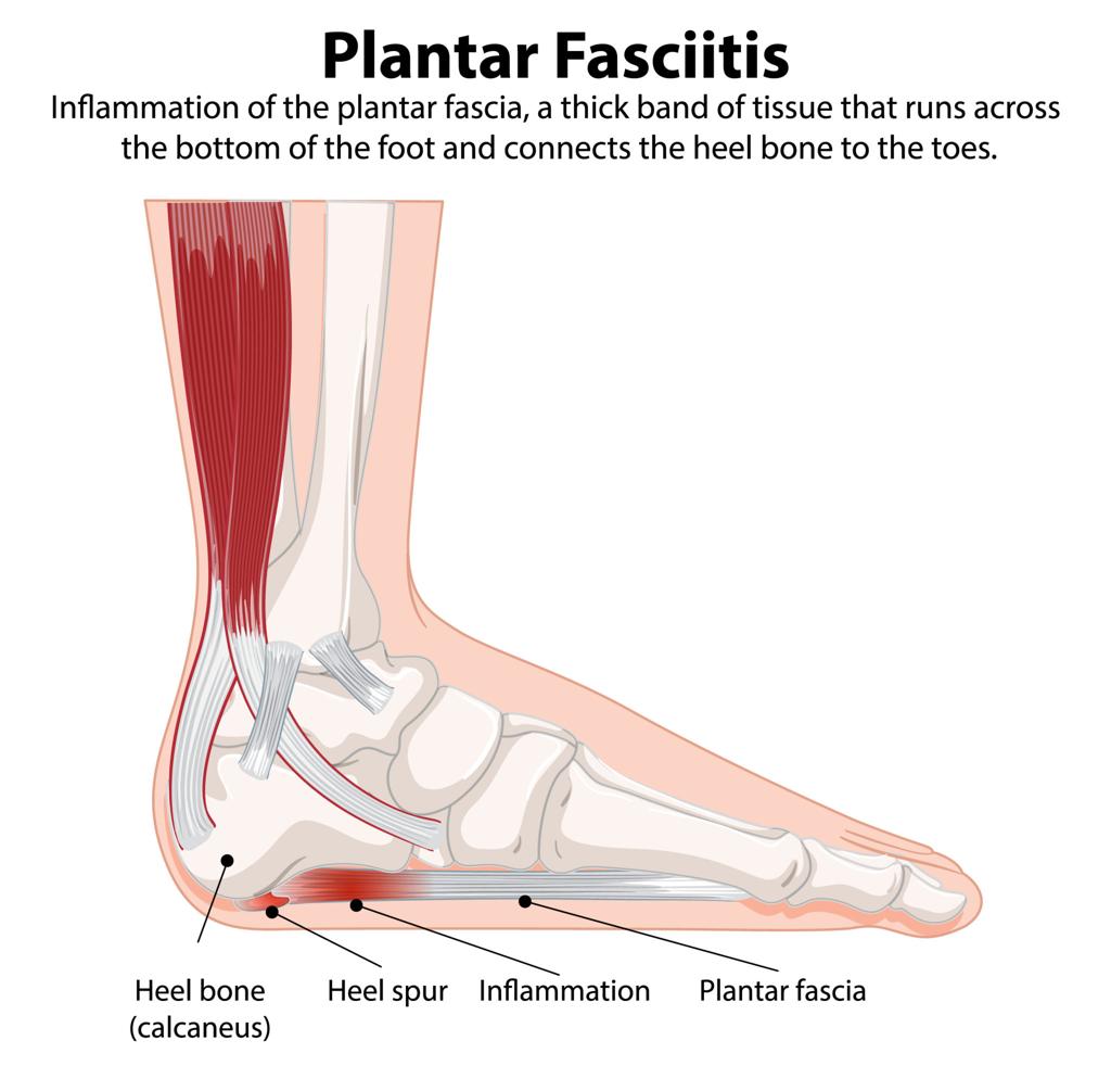 Plantar Fasciitis: Causes, Symptoms, and Effective Relief